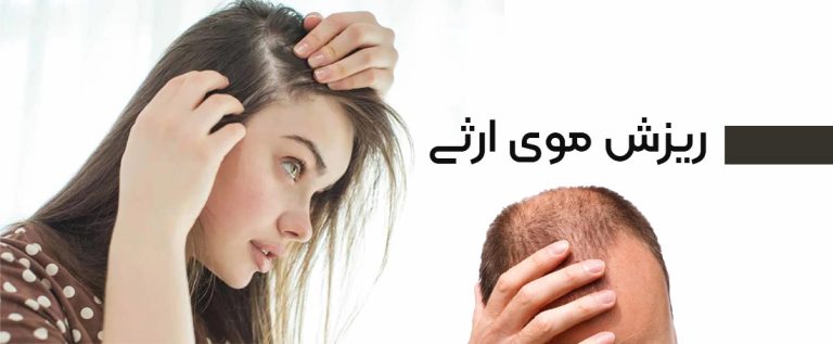 انواع ریزش مو و درمان آن‌ها