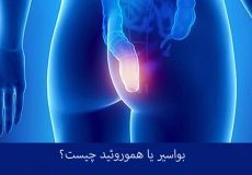 راه های پیشگیری و بهبود هموروئید
