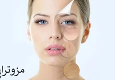مزوتراپی چیست ؟